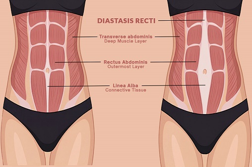 Understanding Diastasis Recti & How Yoga Can Help Recovery