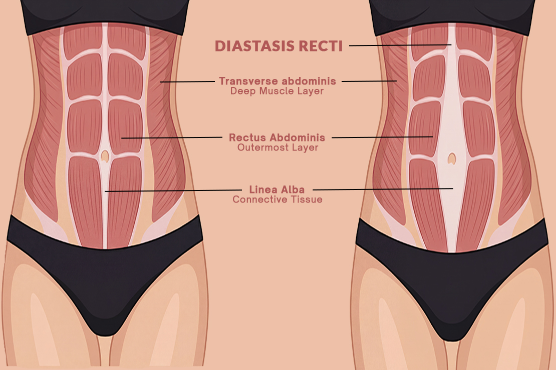 Understanding Diastasis Recti & How Yoga Can Help Recovery Understanding Diastasis Recti & How Yoga Can Help Recovery